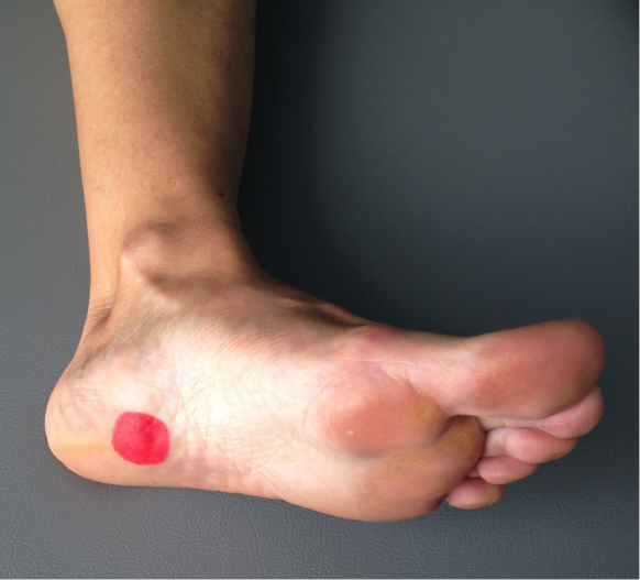 dolor fascitis plantar