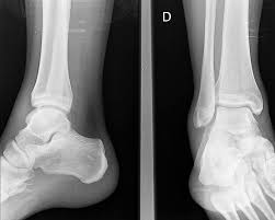 Diagnostico del esguince de tobillo