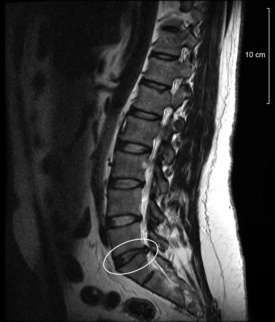 Acerca de la Hernia de Disco Lumbar